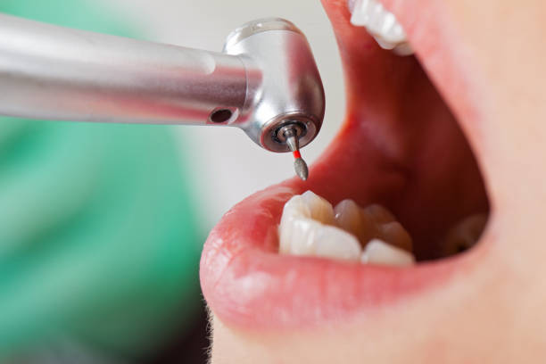 Best Emergency Tooth Extraction in De Soto, MO